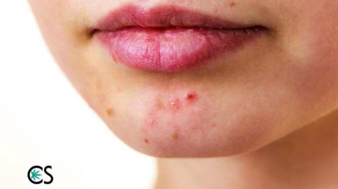 CBD for Acne: Does It Work?